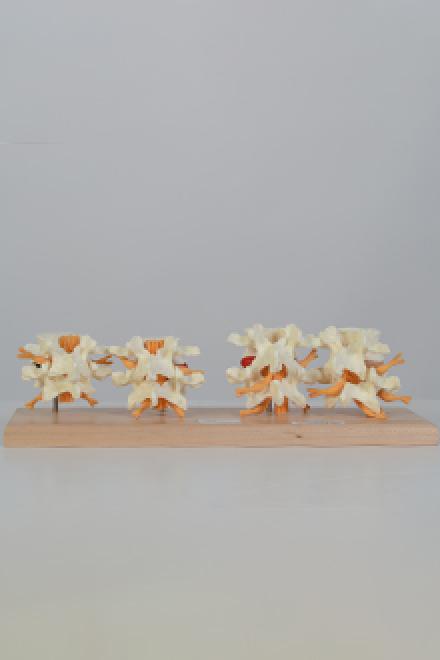 Lumbar spine degeneration model